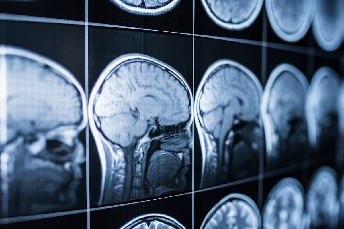 Traumatic Brain Injury Lawyers Portland